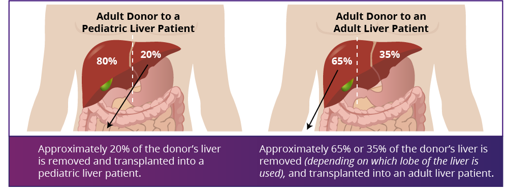 Liver Donor peds and adult