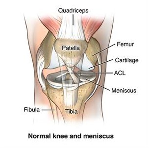 Medical-Condition: Torn meniscus - What is torn meniscus